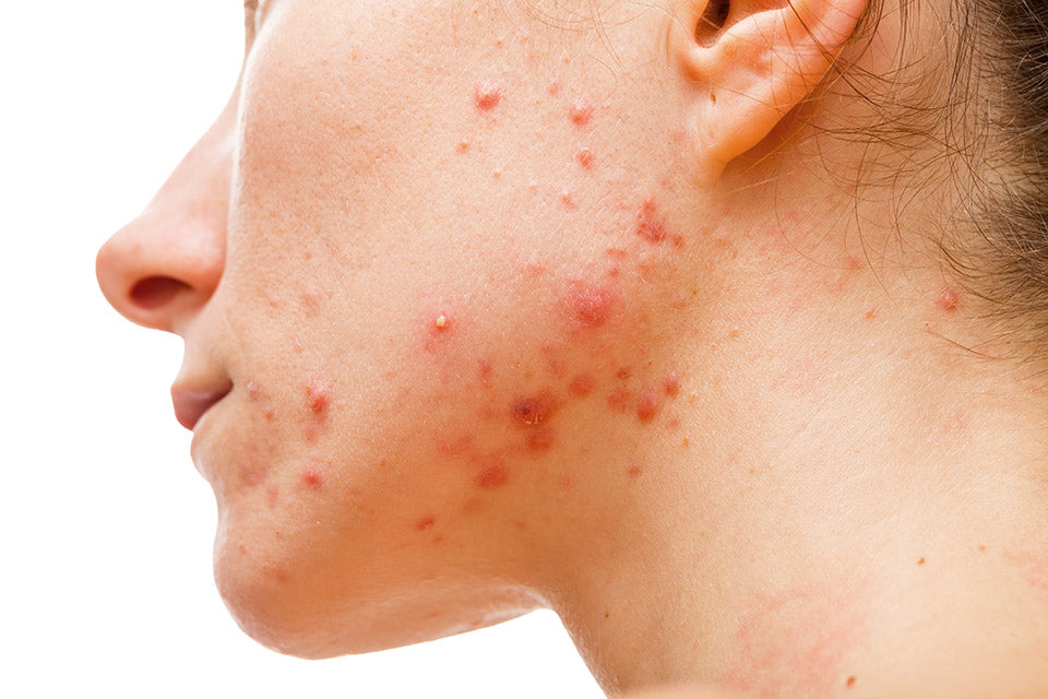 Acne,Skin,Because,The,Disorders,Of,Sebaceous,Glands,Productions|acne-awareness-blog|acne-awareness-small|acne-awareness-small2