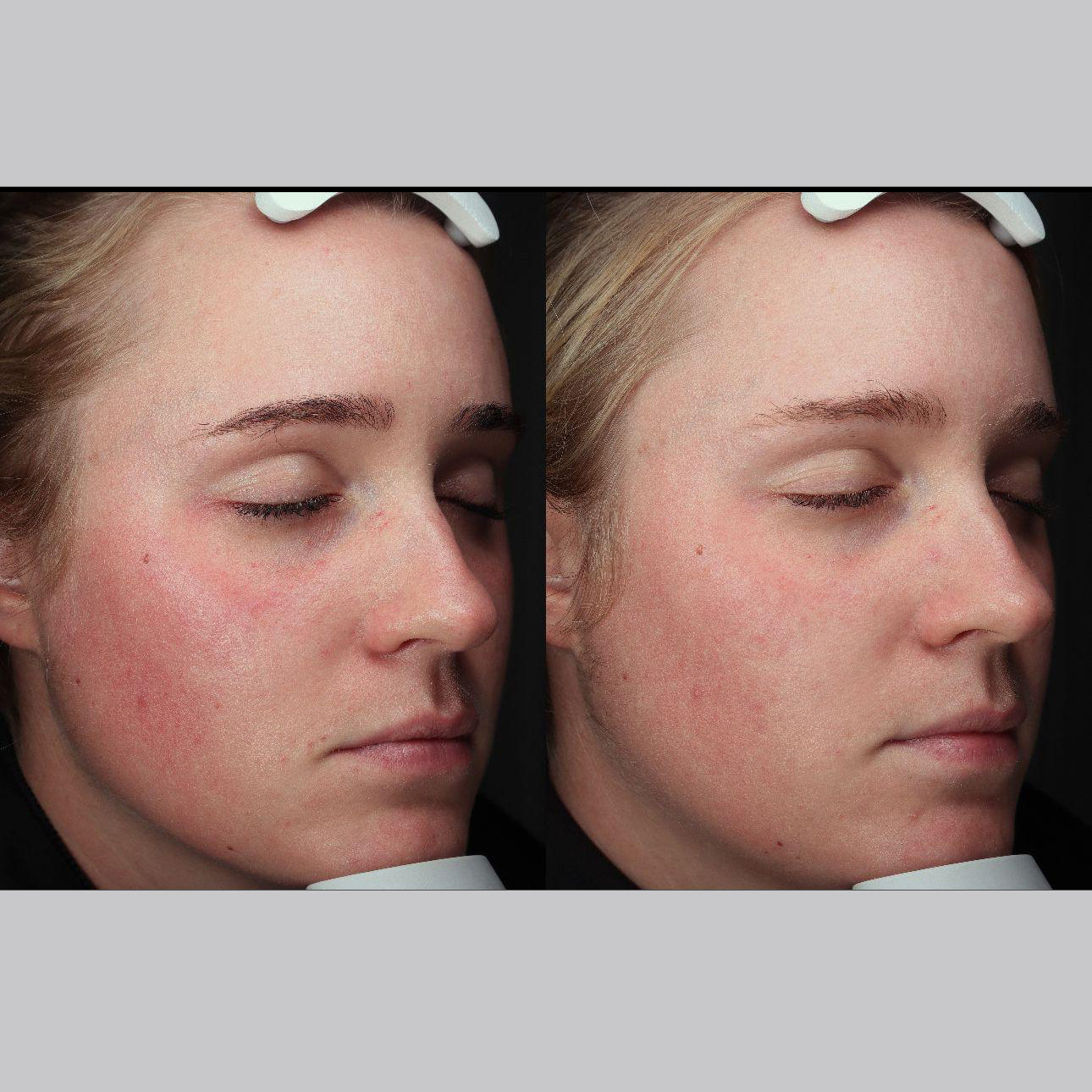 Anti-Redness Power Duo