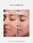 Anti-Blemish Concentrate
