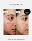 Anti-Blemish Power Duo
