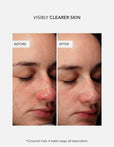 Anti-Blemish Routine