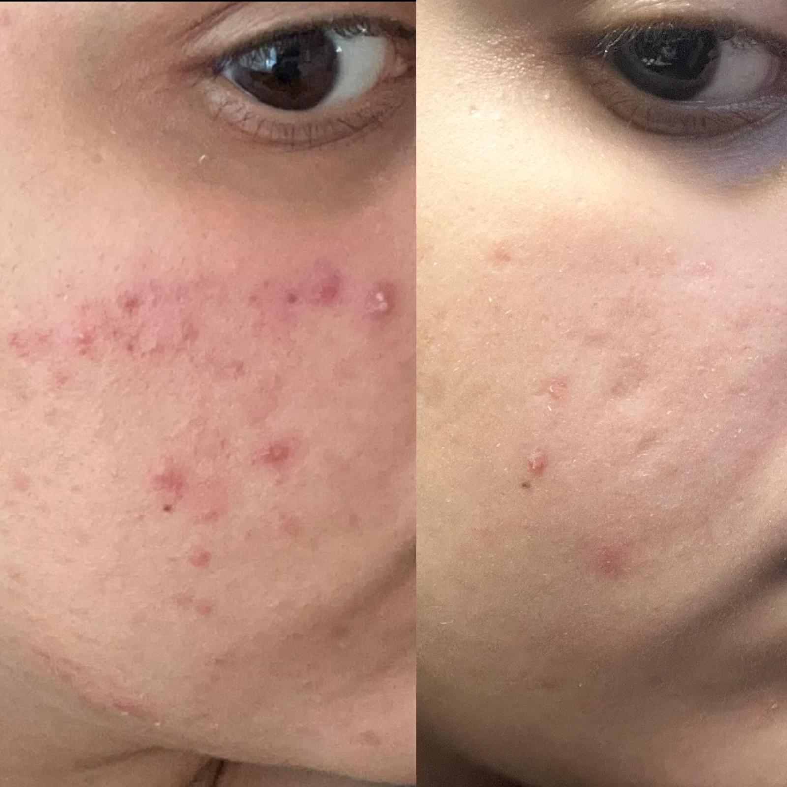 IT’S ACNE AWARENESS MONTH. HERE’S WHAT YOUR BREAKOUTS ARE TRYING TO TELL YOU.