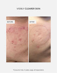 Anti-Blemish Routine