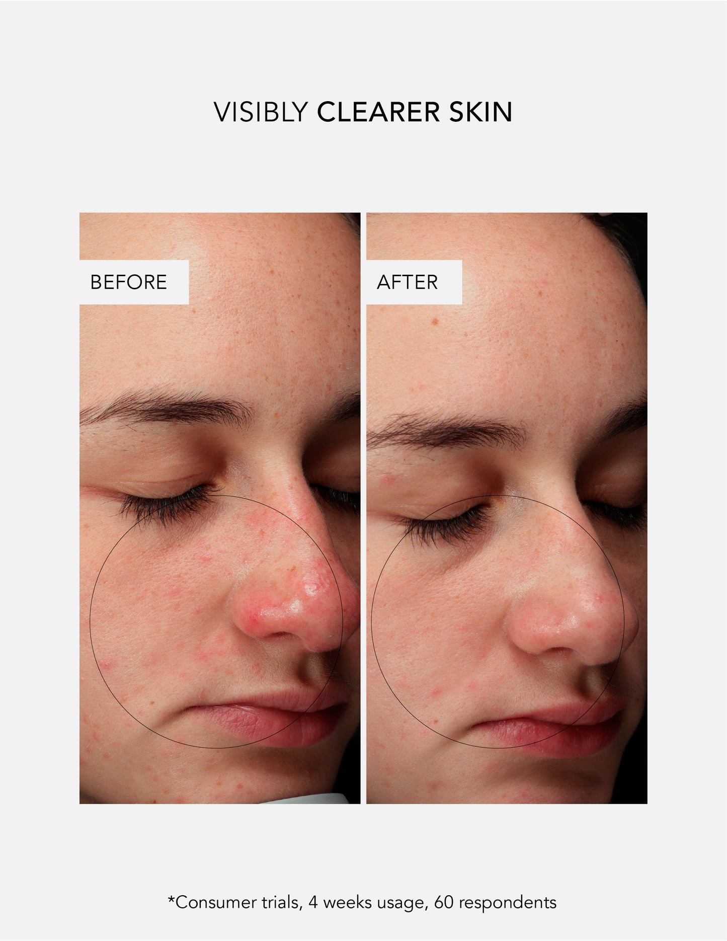 Anti-Blemish Routine