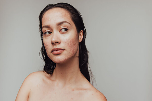 Acne awareness month
